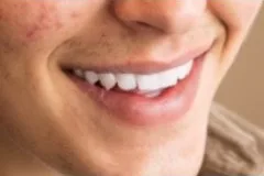 Teeth whitening: Teeth 100
